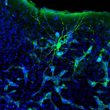 Investigadores españoles hallan una nueva forma genética de alzhéimer