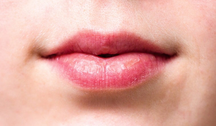 ¿Es el virus del herpes labial una causa desconocida de alzhéimer? ¿Es el virus del herpes labial una causa desconocida de alzhéimer?