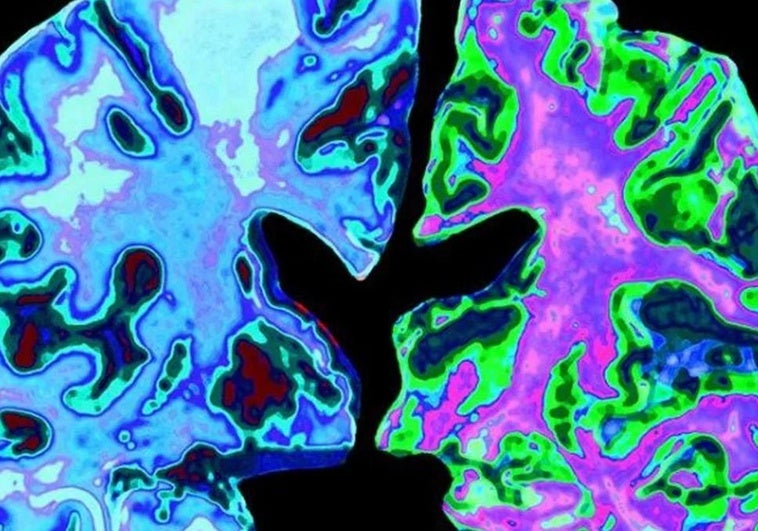 Una analítica de sangre permite conocer la progresión del alzhéimer Una analítica de sangre permite conocer la progresión del alzhéimer