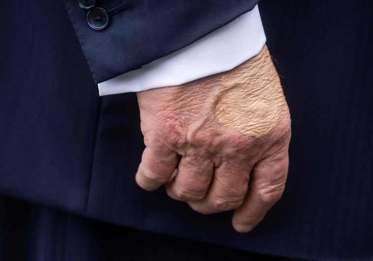 Detectan a Trump hinchazón en las piernas y un moratón en una mano por «estrechar muchas» Detectan a Trump hinchazón en las piernas y un moratón en una mano por «estrechar muchas»